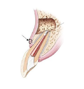 Endo Surgery (apicoectomy)